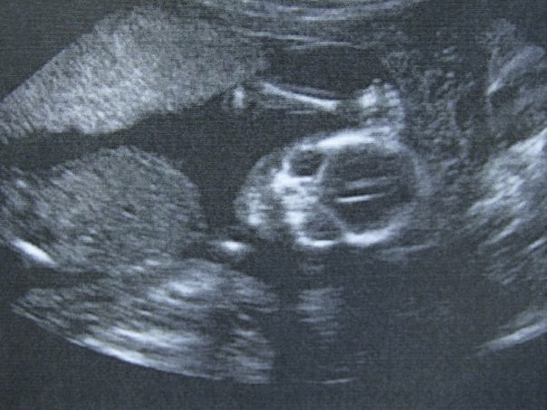 Natasha McKenty Ultrasound of Baby